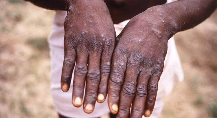 Nigeria records 49 Monkeypox cases