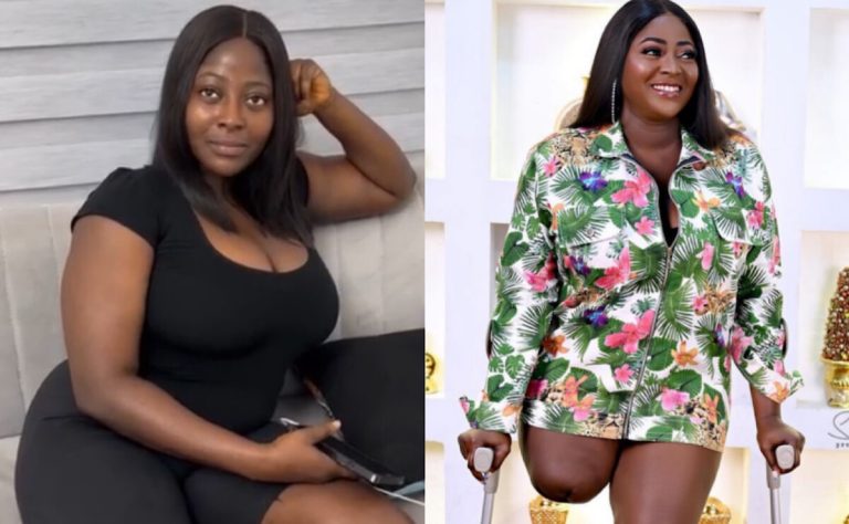 “White men pay me in dollars because they’re attracted to my amputated leg” – Actress Doris reveals