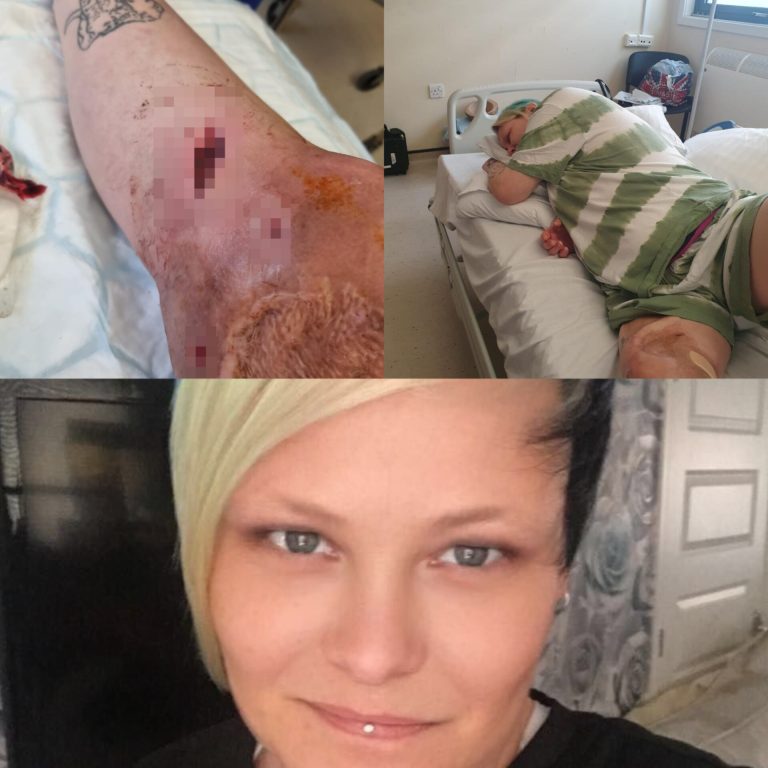 Woman begs to be amputated after scratch she sustained during fishing trip led to 55 surgeries