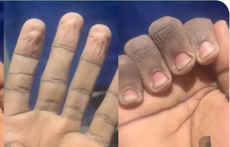 Man shows off state of his hands after washing plates to pay school fees in the UK