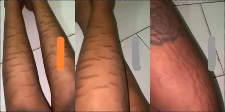 “This is what VDM is fighting against” – Lady in tears after breakout from using skincare products