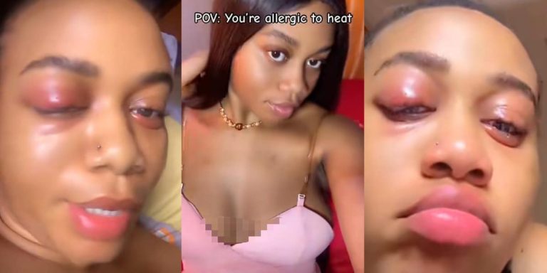 “You sure say na heat, abi na hit?” – Beautiful Nigerian lady’s heat allergy reaction stuns online users