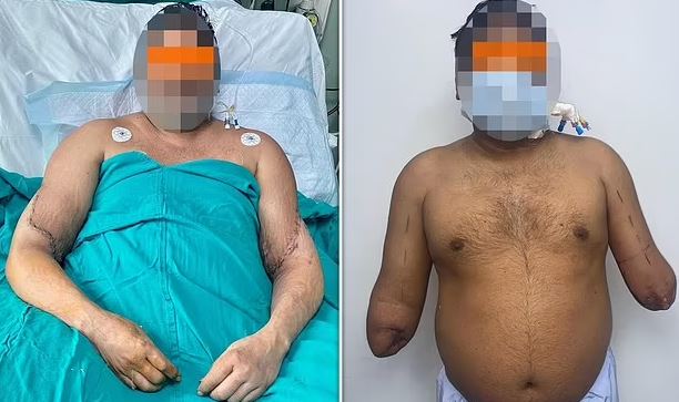 Man undergoes double arm transplant from female donor after losing both limbs in a bike crash (Photos)