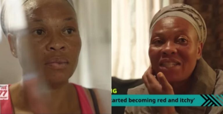 “I used bleaching cream for over 15 years because I was hungry for that beauty, I’m just 35 and I look older than my age now” – Lady cries out (Video)