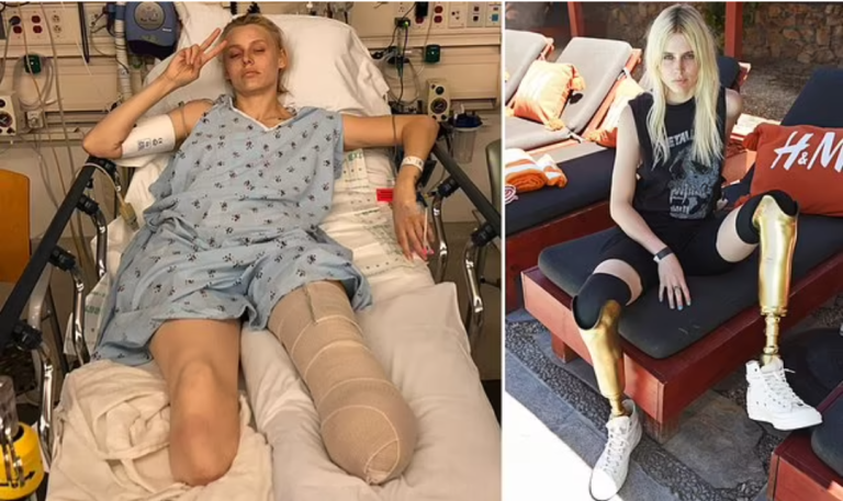 Model reveals how she lost her legs and almost died after using a tampon